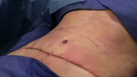 Are You a Candidate for a Tummy Tuck Procedure?